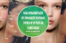КАК ИЗБАВИТЬСЯ ОТ ПРЫЩЕЙ, ЧЕРНЫХ ТОЧЕК И УГРЕЙ ЗА 3 МЕСЯЦА!